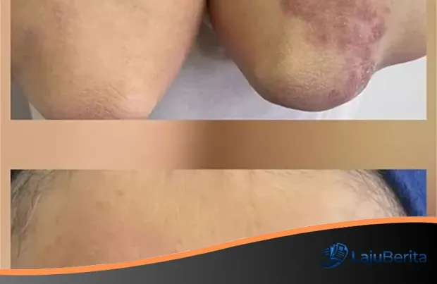 Waspada! Tren Tato Alis Berujung Malapetaka Medis, Wanita Ini Terdiagnosis Penyakit Serius